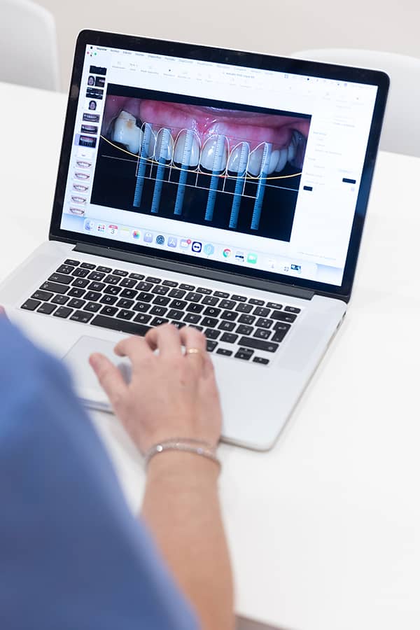 diseño-de-sonrisa-digital-dsd-clinica-dental-cordoba-ventosa