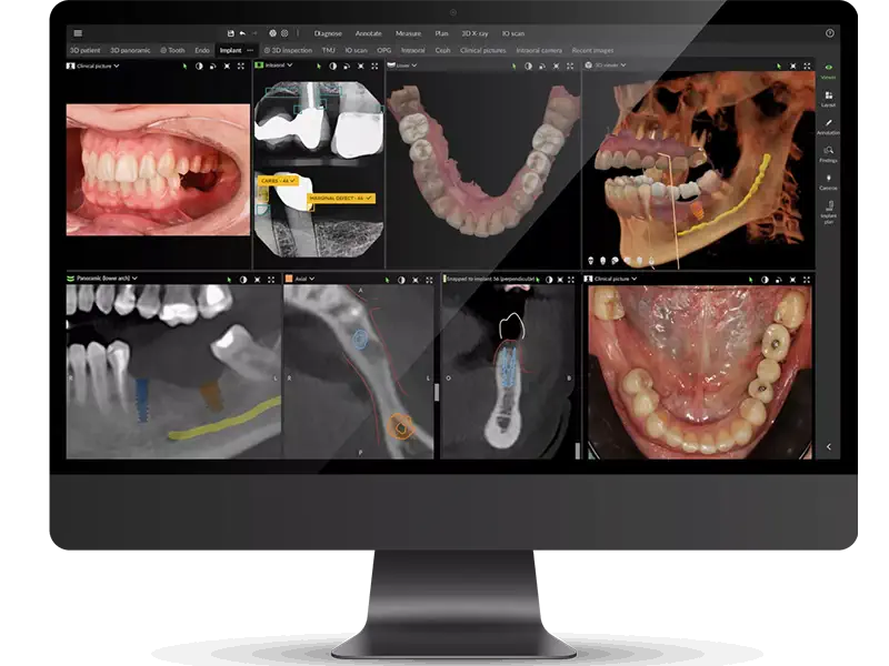 software-implantologia-tac-3d