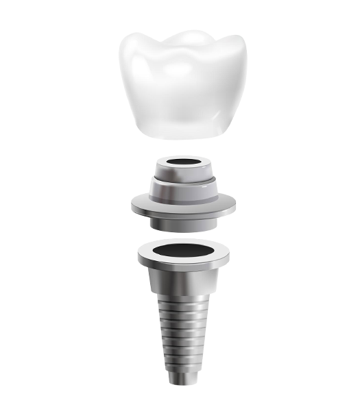implante-dental-clinica-ventosa