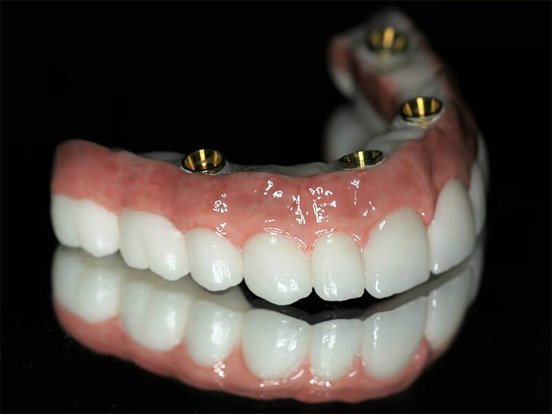 Cuántos-implantes-dentales-se-pueden-poner-en-un-día