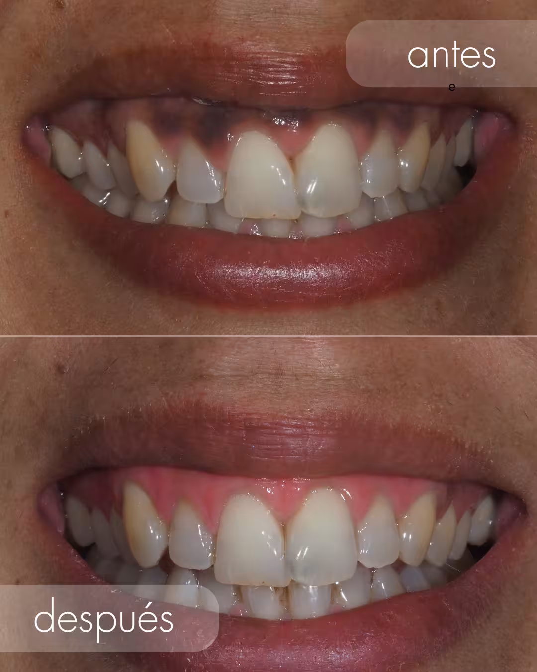 manchas en las encias - melanosis gingival antes y despues