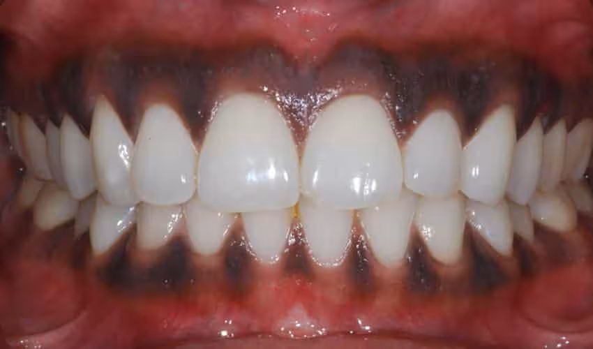 melanosis gingival antes